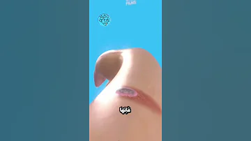 هل يجب فقع بثور الحروق معلومات انشتاين لايك اشتراك تعليق العراق الجزائر معلومات اكسبلور 