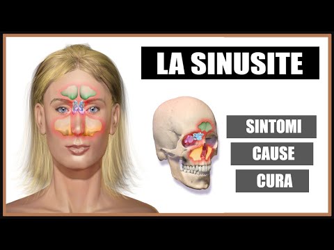 Video: Sinusite Odontogena: Cause, Sintomi E Trattamento