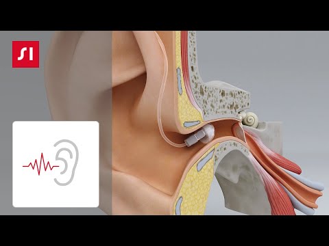 Video: Perdita Improvvisa Dell'udito In Un Paziente Con Melanoma Su Pembrolizumab: Un'eziologia Da Non Omettere Nella Diagnosi Differenziale