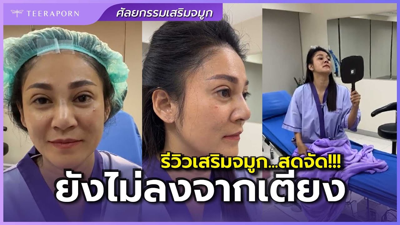 หลังทำจมูกไขมันผสมเนื้อเยื่อเทียมทันทีจากห้องผ่าตัด ไม่ใช้ซิลิโคน ธีรพรคลินิก หมอชลธิศ