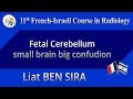 Fetal Cerebellum - small brain big confudion - Liat BEN SIRA