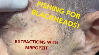 This one has it all Blackheads whiteheads and a bonus Steatocystoma See how I change it up