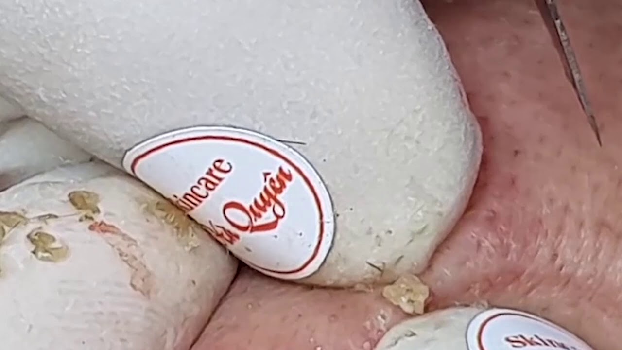 blackheads february 2021