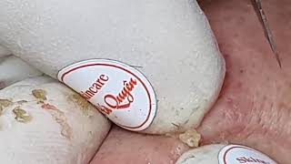 youtube blackheads february 2021