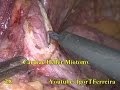 Achalasia - Heller Myotomy - Dor Fundoplication - HD - December 2015 - Complete Surgery