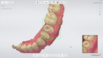 3Shape TRIOS - ポストアンドコア