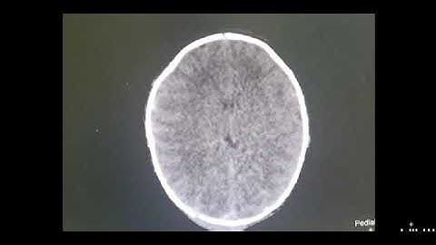 Percutaneous needle aspiration of acute epidural hematoma in a neonate