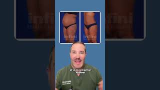 Think you need a tummy tuck for a flat abdomen? Think again. ✨