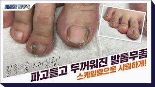 시원하게 발톱 대청소!!🔥 발톱무좀 스케일링!