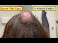 Massive Pilar Cyst Removal. Dr Khaled Sadek. LipomaCyst.com