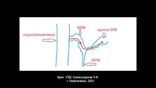 Распространение рефлюкса из бассейна МПВ в  бассейн БПВ