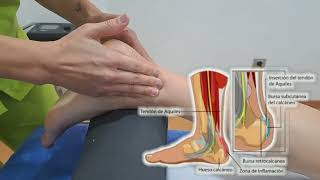 DOLOR TENDÓN DE AQUILES/tratamiento para la inflamación TENDÓN AQUILES MASAJE PASO A PASO .