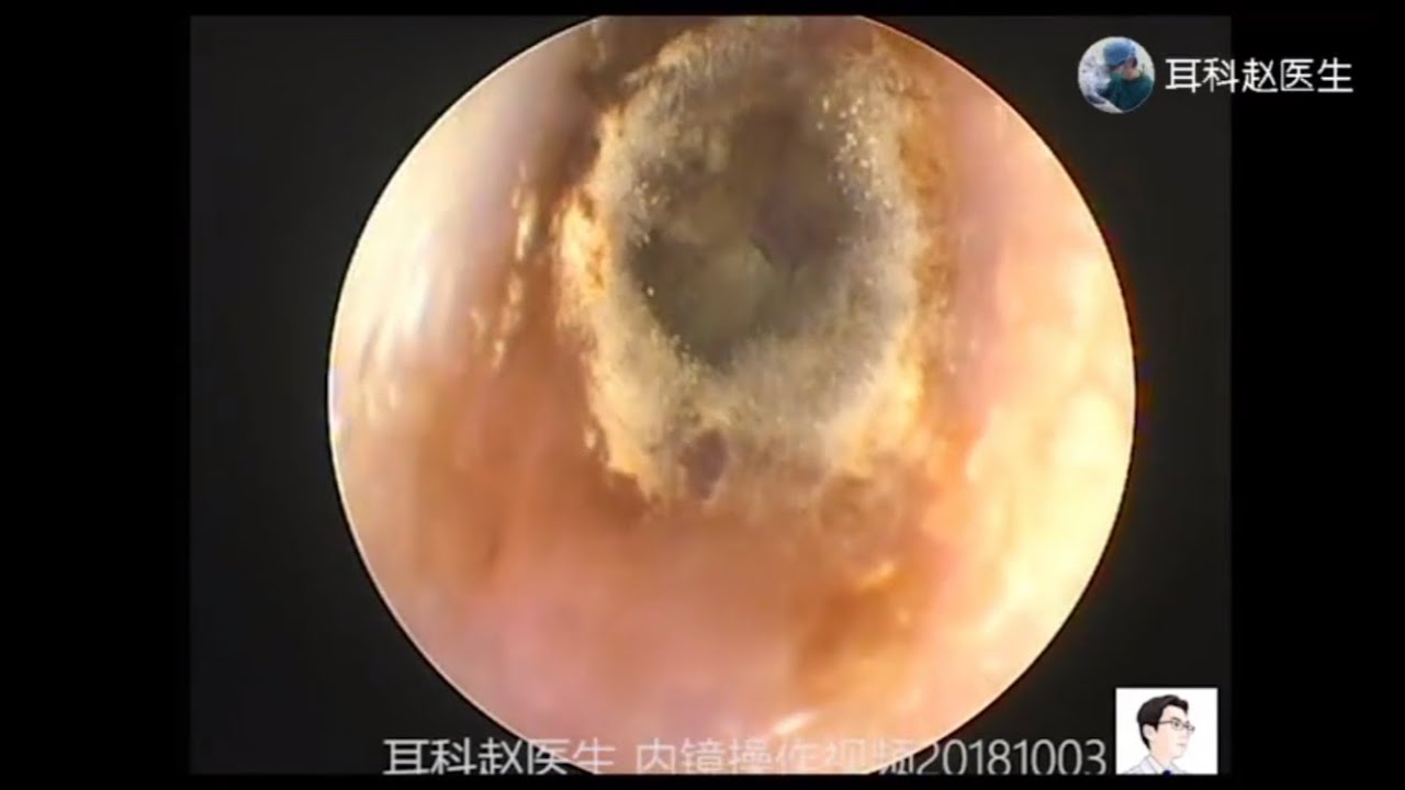 Treatment Of Fungal Otitis Externa By Ear Endoscope For 12 Minutes