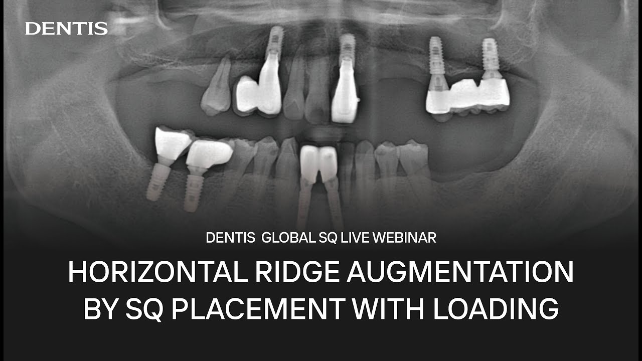 Dentis Concludes Global Webinar Series Highlighting ‘AXEL’ Immediate Placement Strategies
