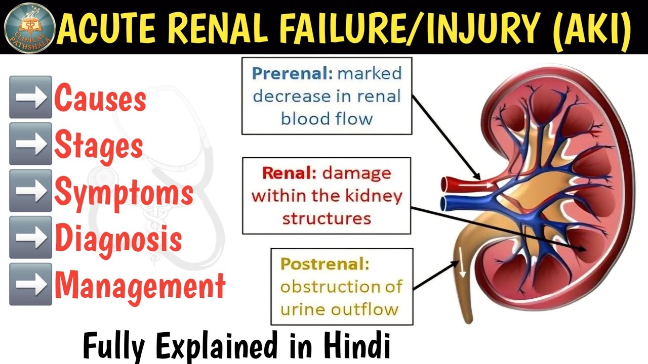 Acute Renal Injury | Causes | Stages | Symptoms | Diagnosis & Management Of ARF/ARI/AKF/AKI/ARD/AKD