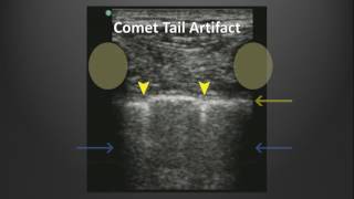 Ultrasound Artifacts