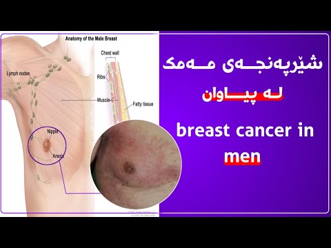 شێرپــەنجەی مــەمک لە پیاوان دەگمەنە بەڵام دەکرێ رووبدات زانیاری لەسەری بزانە 