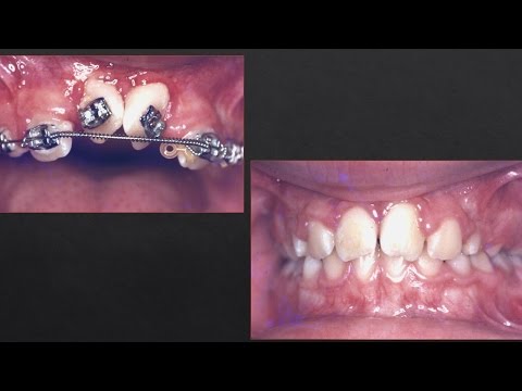 2 Incisors Rotated: Orthodontics