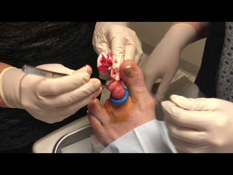 Partial Toe Amputation