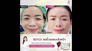 Review ฉีด Botox ลดริ้วรอยที่ Dr.Seen Clinic #คลินิกเสริมความงามเชียงใหม่ #โบท็อกซ์