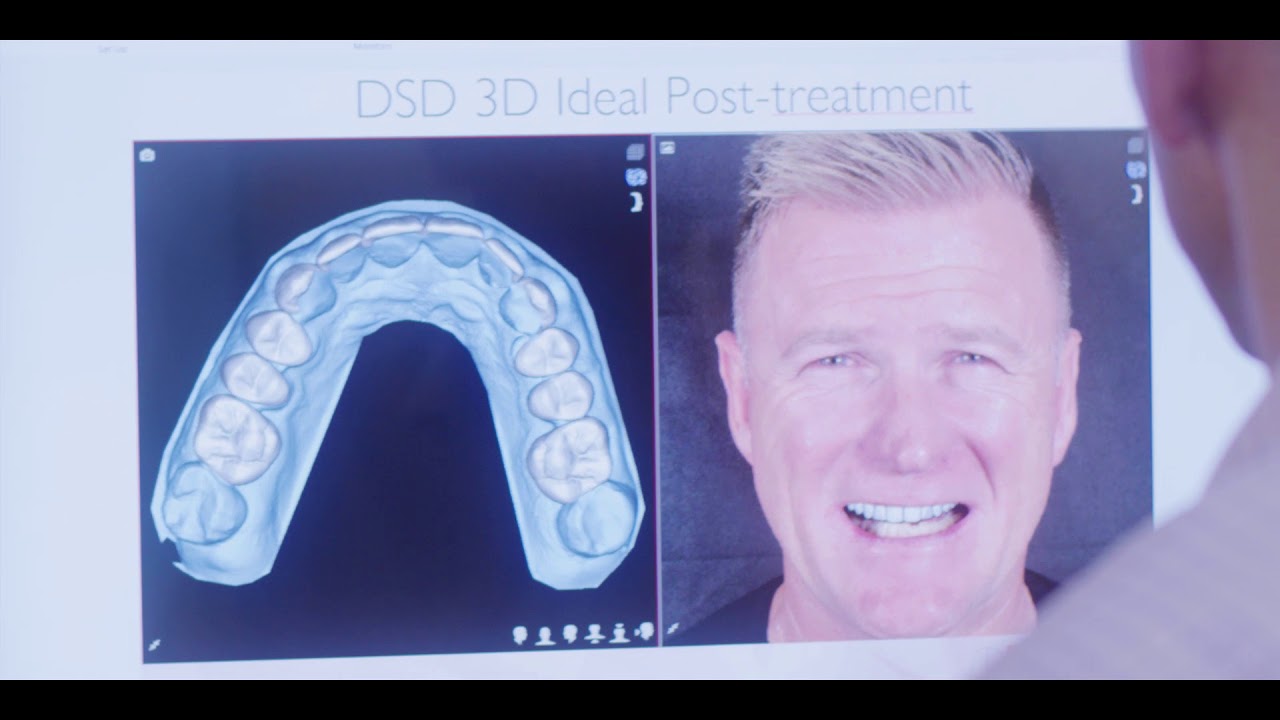 Digital Smile Design (DSD) Transformation | Greg's New Smile by Mona ...