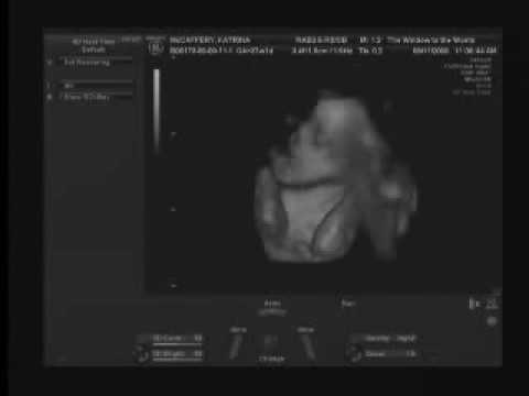 Bryson Gene McCaffery's 27 weeks 4D sonogram