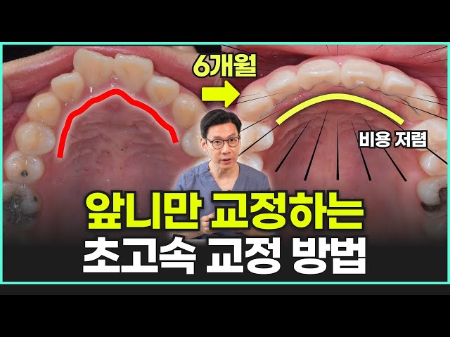 앞니만 부분교정하면 훨씬 예뻐진다! 6개월로 교정 끝내는 방법