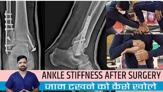 Stiff ankle after surgery exercises in hindi | Ankle fracture physiotherapy exercise & mobilization