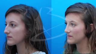 How a Rhinoplasty or Nose Job Works