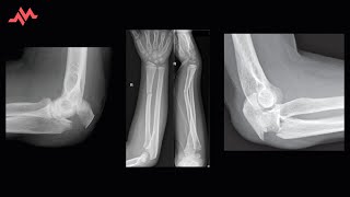 Elbow Pain After a Fall - Case Report