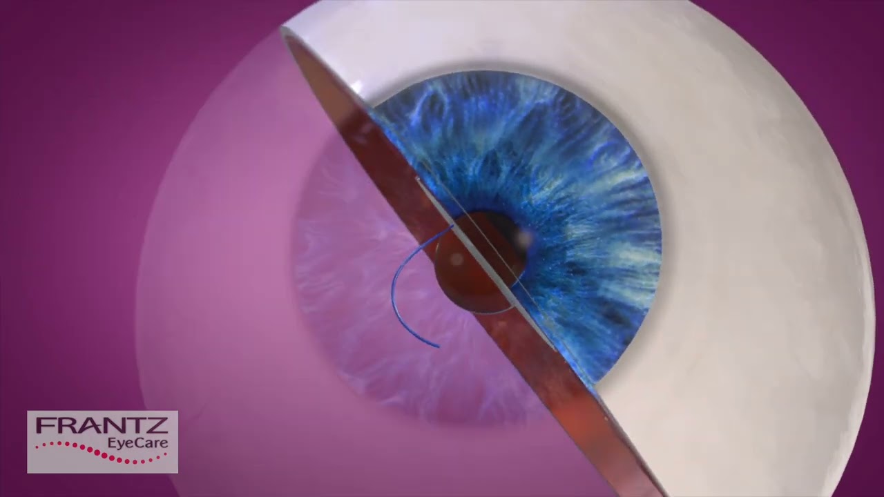 Frantz EyeCare: The Light Adjustable Lens for Cataract Surgery (Short)