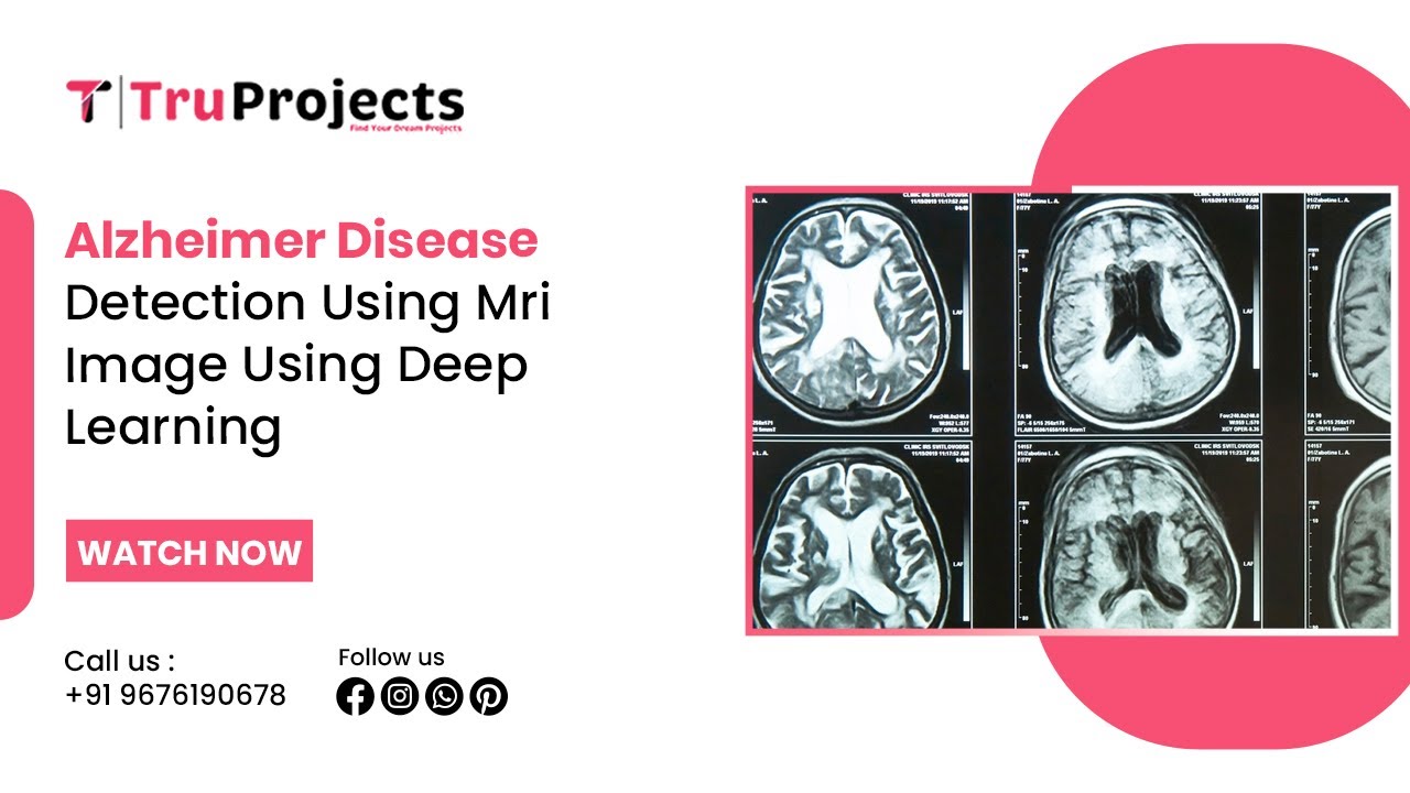 Alzheimer Disease Detection using MRI Image using deep learning - YouTube