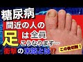 【衝撃】糖尿病間近の人の足は全員こうなります!ちょっとした変化でも見落とすと足切断です。