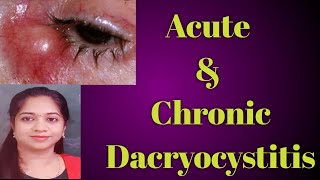 Dacryocystitis || Acute dacryocystitis|| Chronic Dacryocystitis|| Stages of Dcryocystitis|| Mucocele