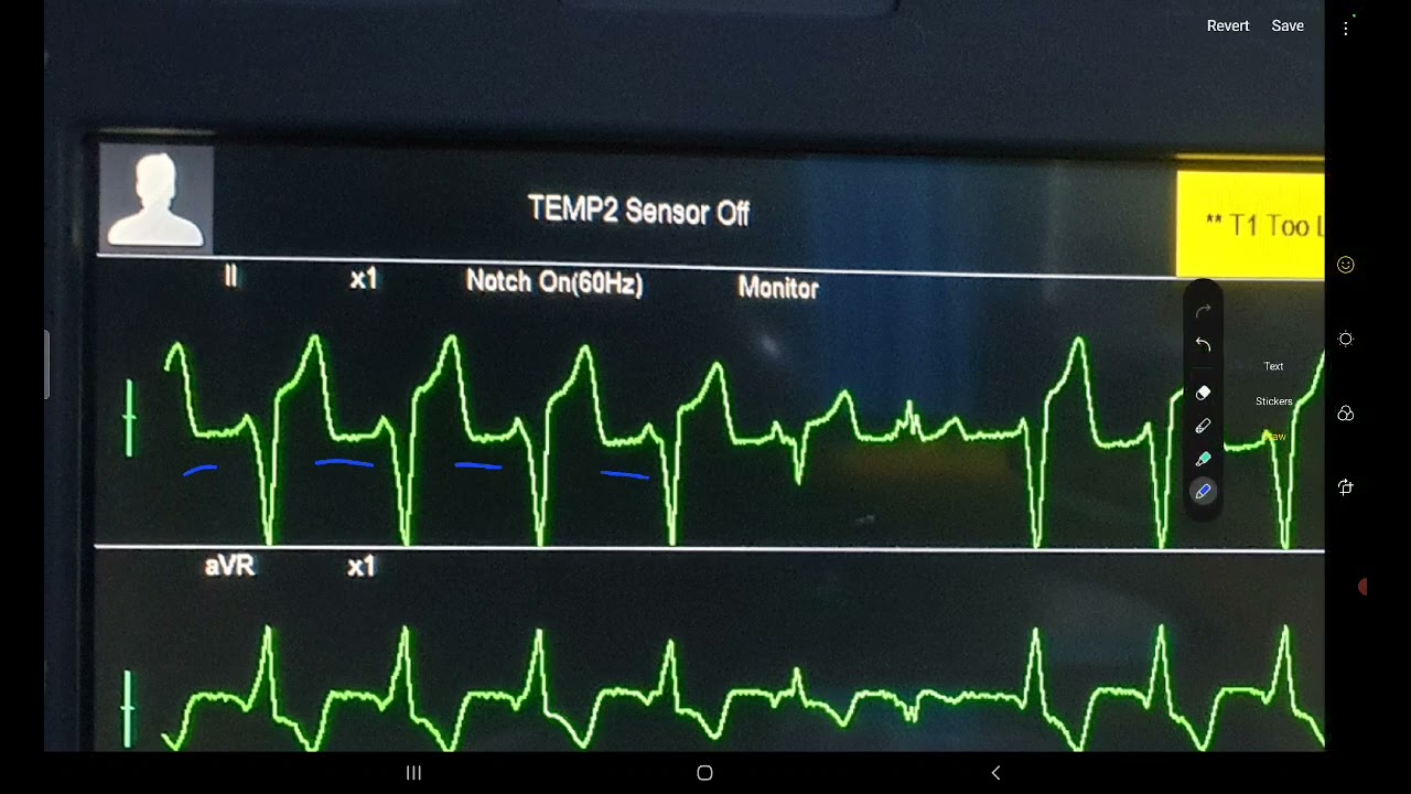 ECG week 21: Dangerous rhythm?