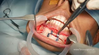 How to Get a Chiseled Jawline For Men - Surgical Procedure
