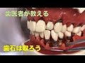 【横浜戸塚　内藤歯科】なぜ歯石除去が大切か？黒い歯石って知ってますか？