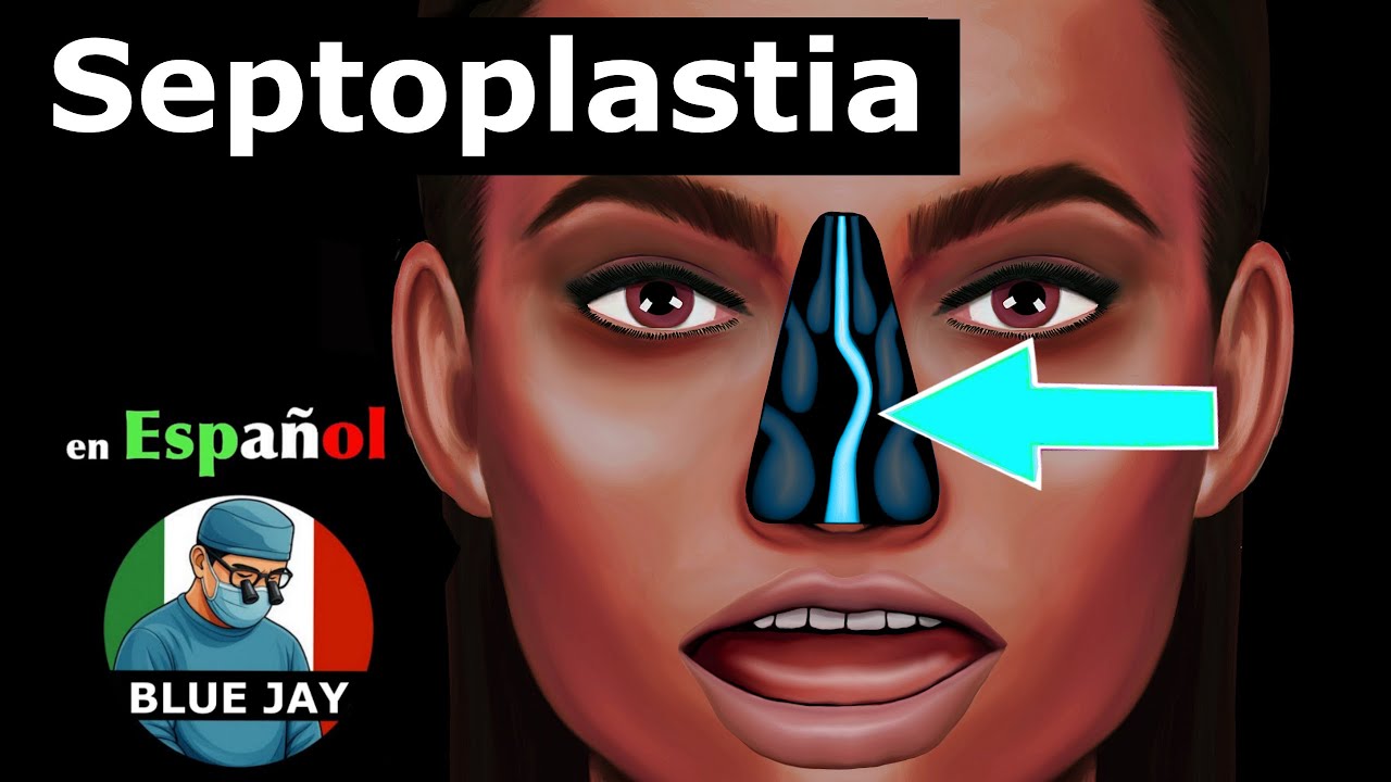 Septoplastia: Educación del Paciente