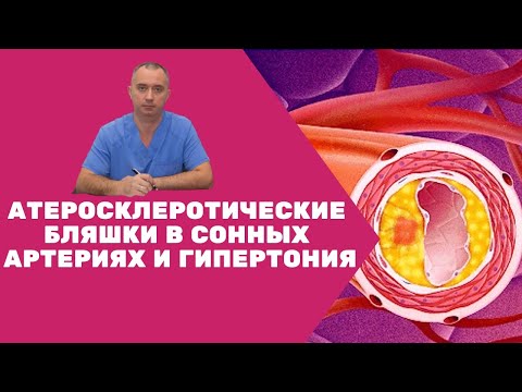 Атеросклеротические бляшки в сонных артериях и гипертония