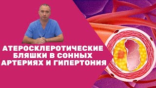 Атеросклеротические бляшки в сонных артериях и гипертония