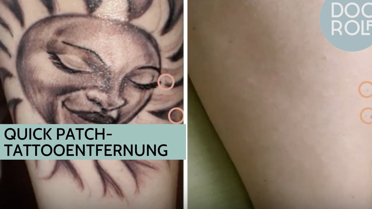 Tattoo Removal - Jazzi Cosmetic Surgery & Aesthetic Medicine