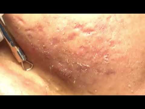 cystic acne, pimples and blackheads extraction acne treatment on face!!! part 