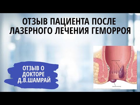 Лазерное лечение внутреннего геморроя. Отзыв пациента