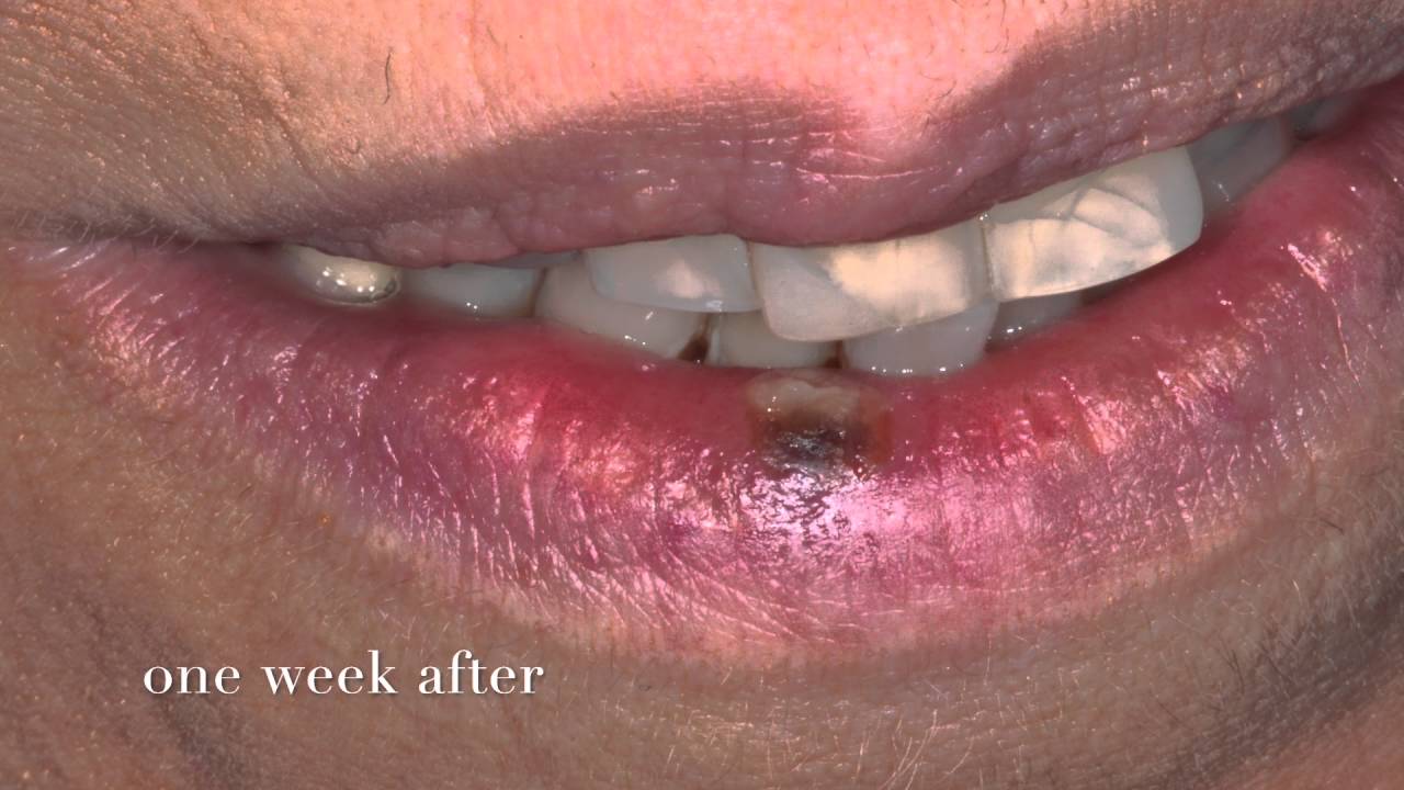 Rimozione emangioma dal labbro con laser senza anestesia - YouTube