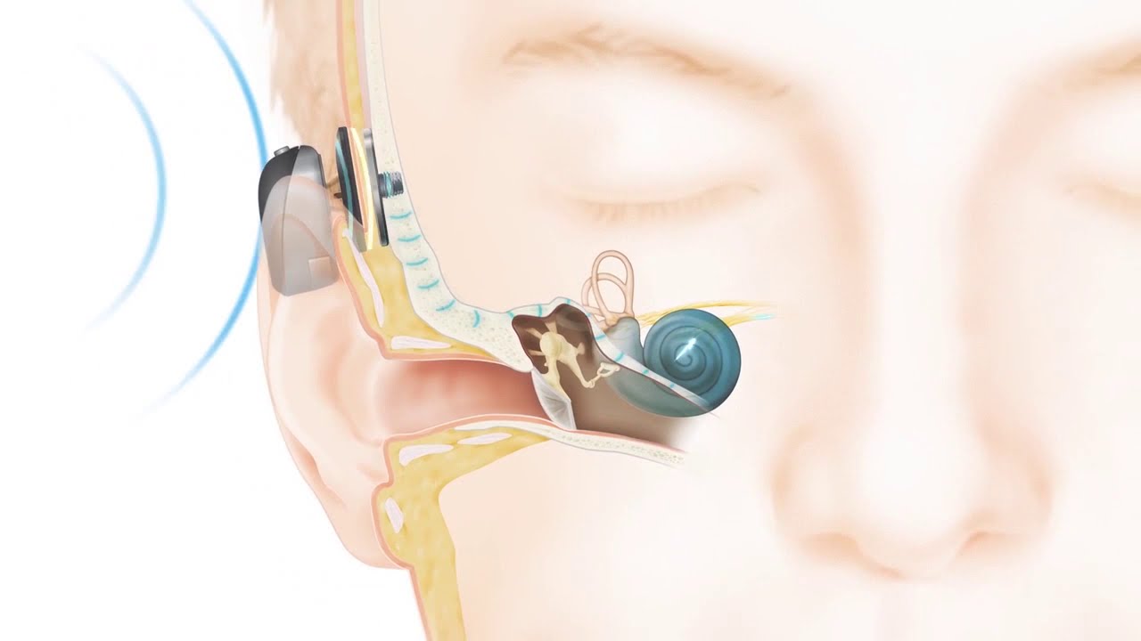 How the Cochlear™ Baha® Attract System works