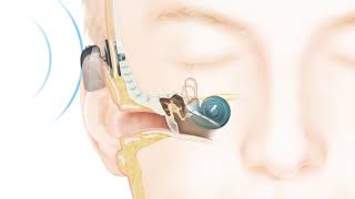 How the Cochlear™ Baha® Attract System works