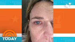 Savannah Guthrie I Cried After Follow-Up Eye Surgery Today