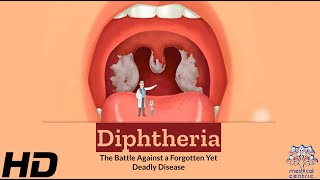 Diphtheria The Silent Battle Against A Deadly Disease