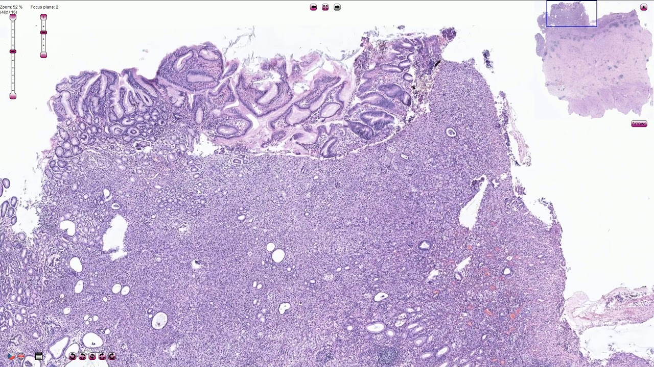 Poorly Cohesive Adenocarcinoma, Stomach - Histopathology