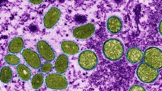 What Is Monkeypox? Monkeypox Explained